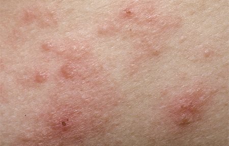 Cận cảnh da khô và bị đỏ