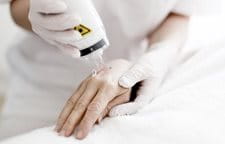 Hình ảnh liệu pháp laser được sử dụng trên tay của người phụ nữ