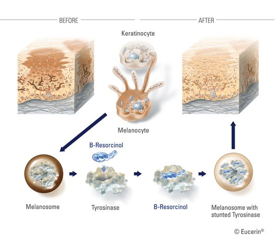 Minh họa về Chứng tăng sắc tố da trước và sau khi được điều trị với Eucerin Even Brighter