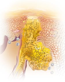 Hình ảnh minh họa về mụn trứng cá