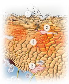 Minh họa làn da với các triệu chứng của bệnh Viêm Da Dị Ứng