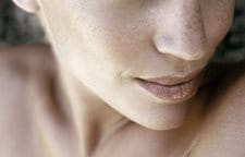 Tàn nhang thường xuất hiện trên vùng mặt