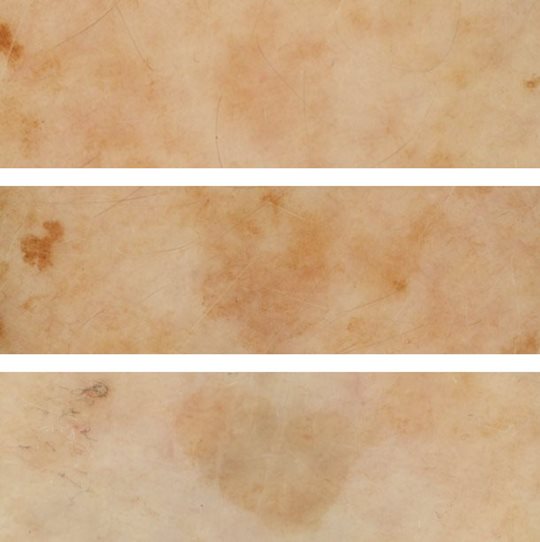 Sản phẩm Eucerin EVEN BRIGHTER làm giảm vết thâm rõ rệt sau 12 tuần.