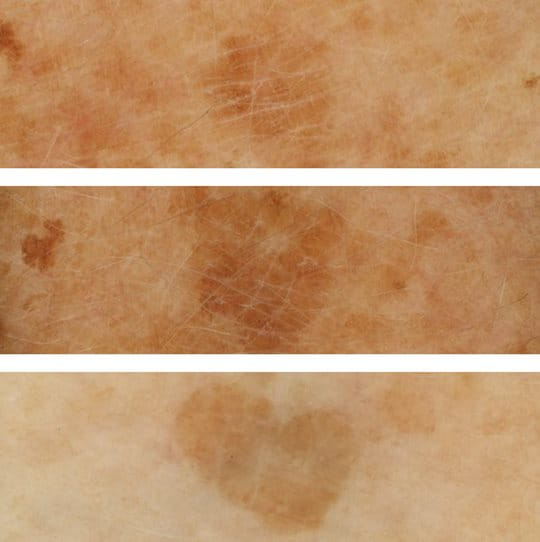 Sản phẩm Eucerin EVEN BRIGHTER làm giảm vết thâm rõ rệt sau 12 tuần.