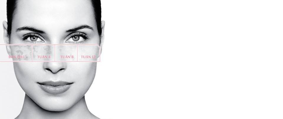 Chứng tăng sắc tố da được cải thiện trong quá trình điều trị trên da nữ giới