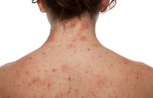 Lưng của người phụ nữ với làn da bị nhiễm trùng