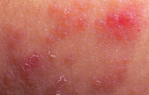 Làn da bị nhiễm trùng, dễ bị bong tróc