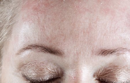 Hình ảnh vùng trán bị tróc vảy của người phụ nữ